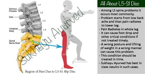 s1 compression test|s1 compression symptoms.